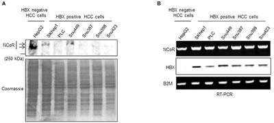 Autophagic Degradation of Misfolded Nuclear Receptor Co-repressor (NCoR) Is Linked to the Growth of Tumor Cells in HBX Positive Hepatocellular Carcinoma (HCC)